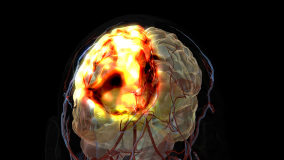 Isolated damage to the brain frontal lobe after a thrombus or embolus causing decreased perfusion to the region of nervous/brain tissue